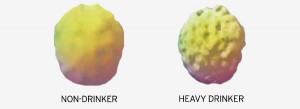 These brain scans show functional activity levels in the brain of a healthy non-drinker (left), and a sober 21-year-old with a four-year history of heavy alcohol use (right). The “holes” indicate areas of reduced brain activity. © Dr. Daniel Amen; www.amenclinic.com